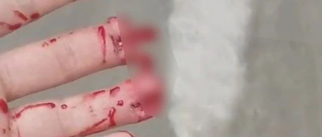 师傅换电梯钢丝绳，手指被夹断三根！